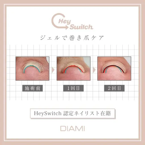 巻き爪ケア1本【Hey Switch】