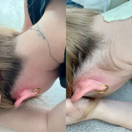 うなじワックス脱毛