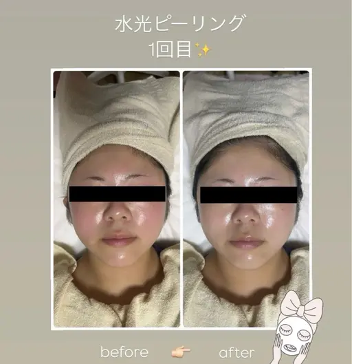 剥離なし❣️渡韓なし❣️韓国肌ケア人気No.1✨【水光ピーリング】➕ヘッド➕デコルテマッサージ付き💆🏻‍♀️
