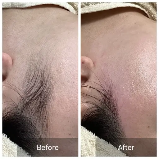 成人式前限定🌸うなじ＋顔周りWAX脱毛