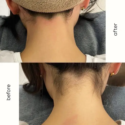 【うなじ美人】うなじWAX脱毛　¥3,500