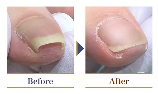 限定１０名様 巻き爪補正(1爪)予約時利用条件：お写真の撮影・口コミ投稿にご協力頂ける方※2爪目からは通常価格