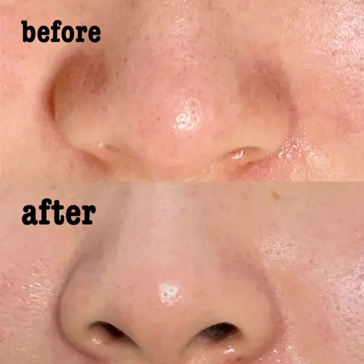 【フェイシャル毛穴ケア】ウォーターピーリング✖️ヒト幹細胞培養液ポレーション導入