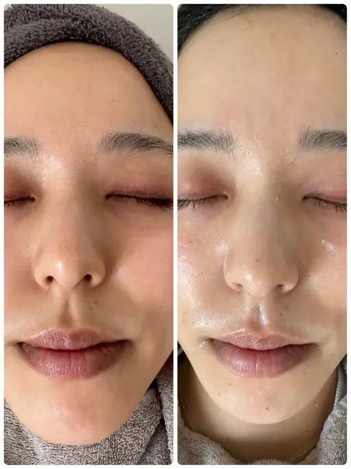 【REVI】陶肌トリートメント【剥離なしハーブピーリング】