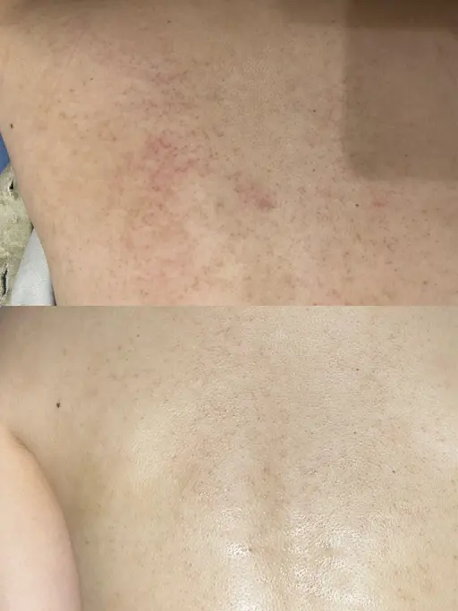 【女性限定💖】背中のハーブピーリング🌿