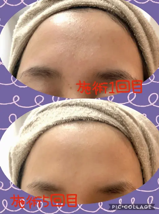 【フェイシャルベーシック+上下まつ毛パーマ😊】リンパマッサージでお顔スッキリ🌈上下のまつ毛パーマでメイク時短✨