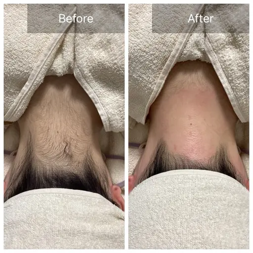 即日うなじ美人✨うなじWAX脱毛