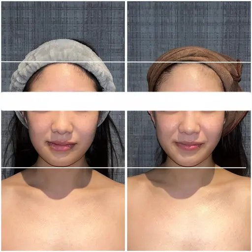 【🌸4月中5名様限定🌸】首肩こりを楽にして小顔にするこりとりコルギ+オプション付き💕90分❣️