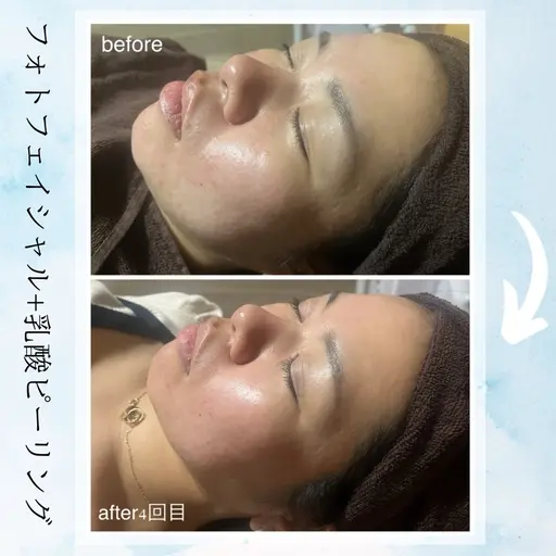《新規》ツヤっと毛穴レス水光肌💎✨【毛穴/透明感】乳酸ピーリング+IPLフォトマシン(剥離なし)