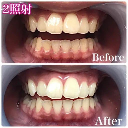 祝⭐全国最安値⭐歯科医提携サロン🦷ホワイトニング2回照射2000円🌈芸能人御用達サロン❤