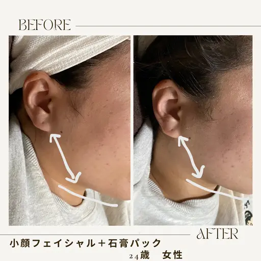 ☆肌質改善に!【お着替え不要!】EMS付き小顔矯正マッサージ×ハーブピーリング50分［たるみむくみ/ニキビケア/毛穴］