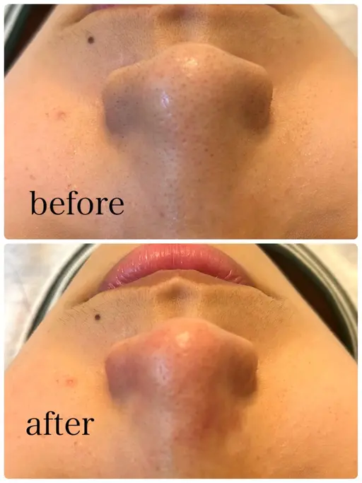 毛穴洗浄スチーマー付き🩵