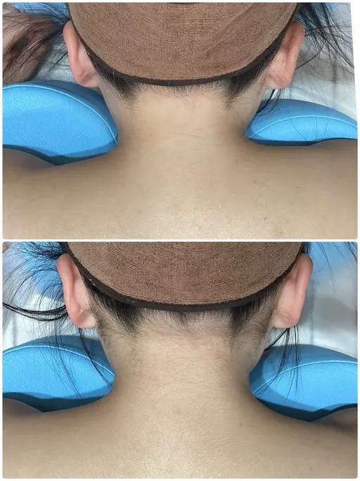 2026年成人式前うなじ脱毛👘🎍脱毛未経験の方大歓迎🥳着物を着るなら襟足の脱毛は必須です✨