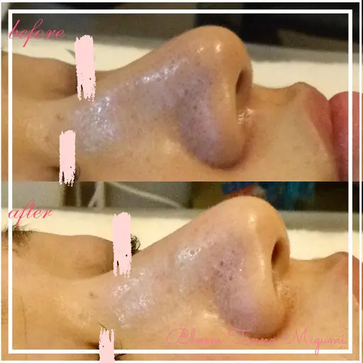 毛穴レスコース　　70分✨🆕メニューキャンペーン✨