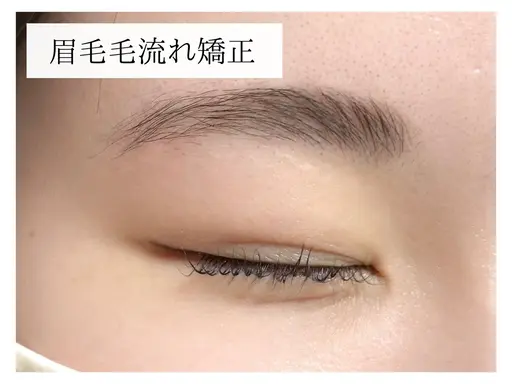 眉毛毛流れ矯正