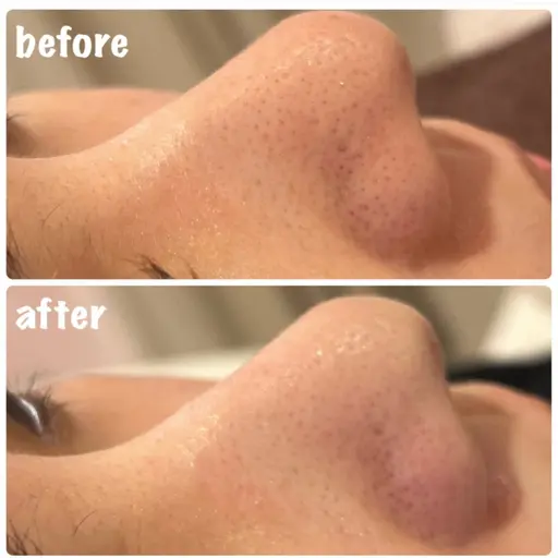 【期間限定】✨🪞ハイドラ×ビタミンC超音波導入セット🪞✨