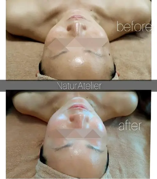 小顔コース症例モデル・モニターさん募集⭐《before/after》写真のご提供をお願いします。