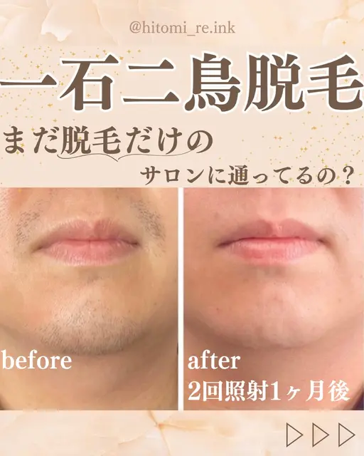 【急な予定にも対応】メンズひげ脱毛　鼻下/顎/顎下30分