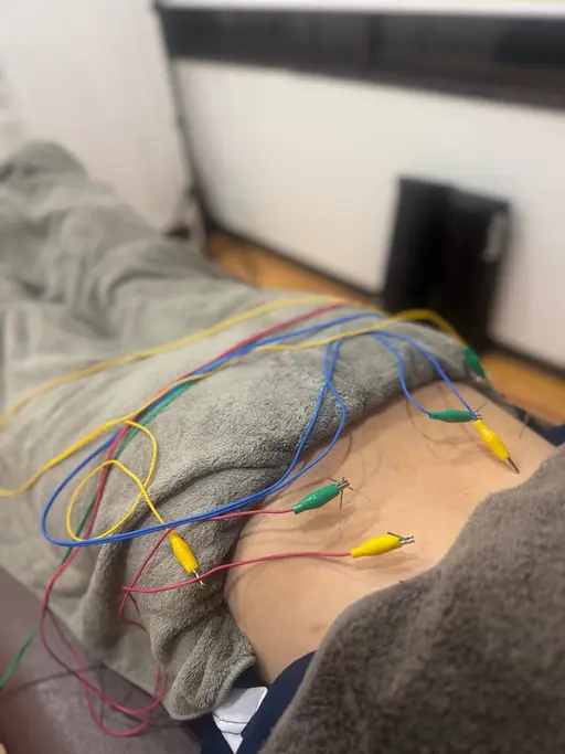 尿漏れお湯漏れ鍼