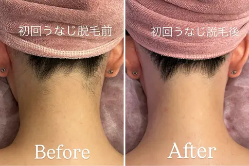 【2位🥈背中・うなじ脱毛✨¥13000→¥11000】(シェービング/角質ケア/保湿付)ご新規様限定🪽 回数:1回