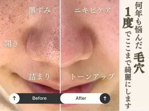 毛穴洗浄+お顔脱毛+うるうる水分パック