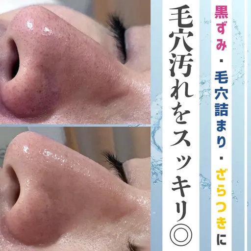 〈毛穴の黒ずみに🌟〉ハイドラフェイシャル