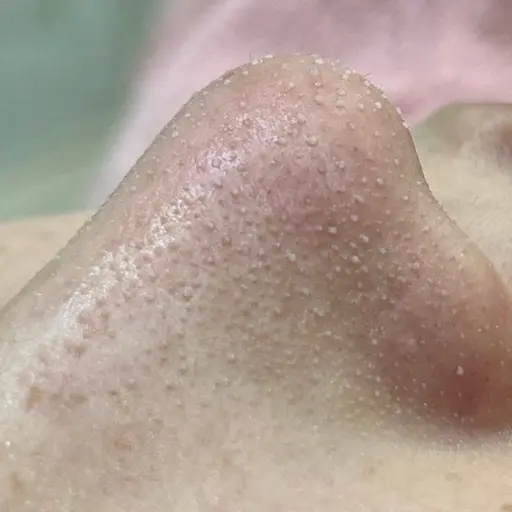 溶かす角栓毛穴吸引【鼻顎眉間の気になる部分角栓除去ケア】徹底的に黒ずみキレイに¥5980