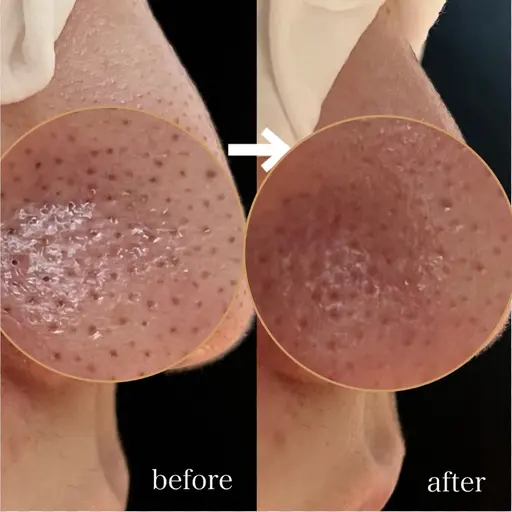 当店オリジナル毛穴ケア【2種類の機械×ハンド技術で毛穴黒ずみ撃退】ピーリング付（70分）￥2,000引