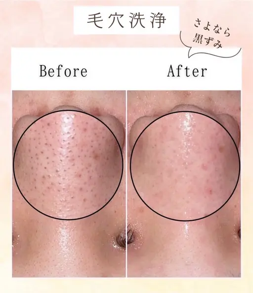 ㊗️成人  フラットラッシュ120本+毛穴洗浄🫧