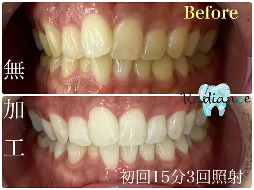 【人気No.1】初回15分3回照射🦷一気に白く！オーダーメイドセルフホワイトニング🦷確実に白くしたい方にオススメ！