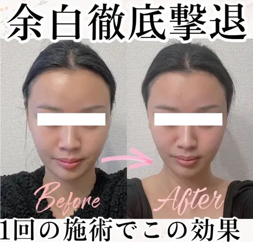 20代限定🌟SNS映え美小顔🖤写真写りが劇的に改善！痛くないオールハンド施術💆🏻‍♀️浮腫みたるみほうれい線に✨