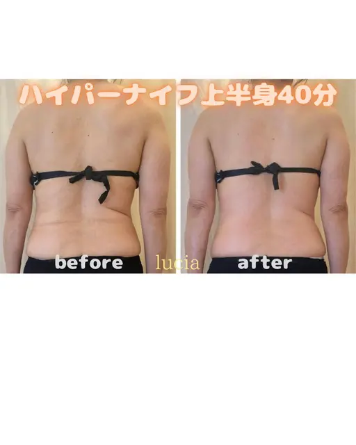 ✨オープン記念価格✨【脂肪撃退×ライン造形】ハイパーナイフで「落ちない」をやっつける🔥上半身集中✨40分