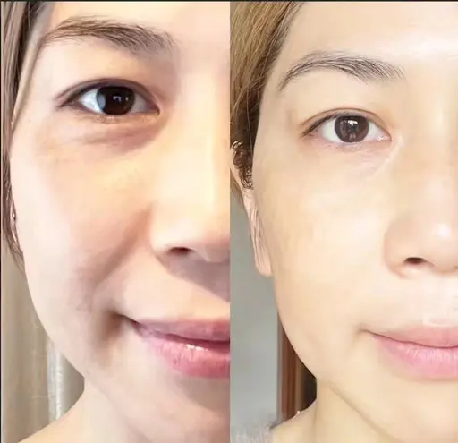 モニター価格⭐　リフトアップ/乾燥肌/ニキビ肌/お肌のお悩み⭐肌改善/臍帯由来&エラスチン　水光噴射