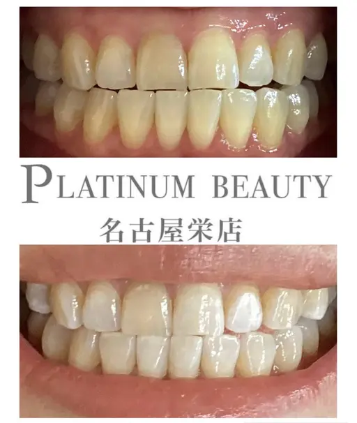 【平均3​〜​4トーンアップ】初回から効果を感じたい方へ✨〈20分×2回〉業界最高クラスの高出力照射