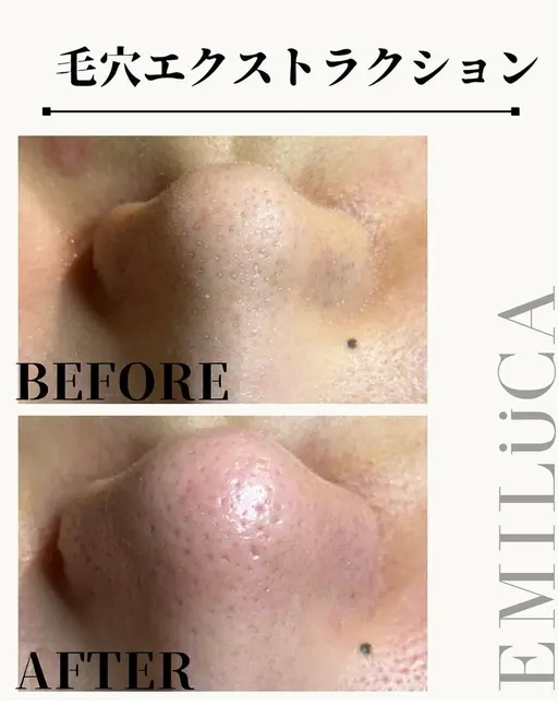 毛穴エクストラクション🍓✨