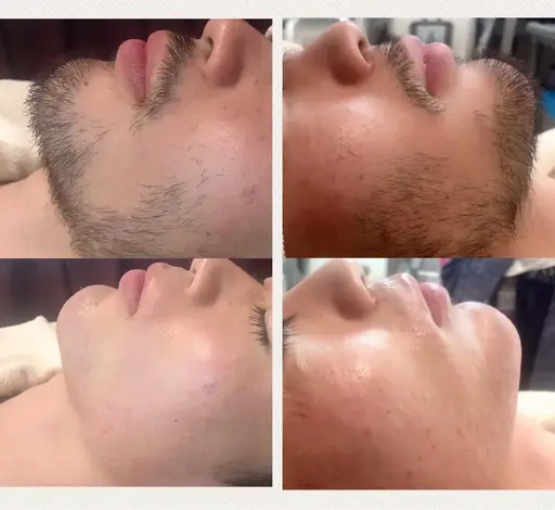 ひげ脱毛🧑🏻‍🎤男の身だしなみ🤩メンズひげ脱毛で男前を上げませんか？