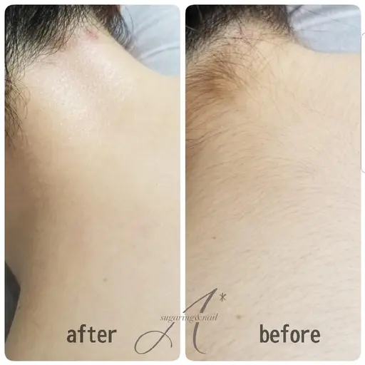 VIO&脇orうなじシュガーリング🍋脱毛