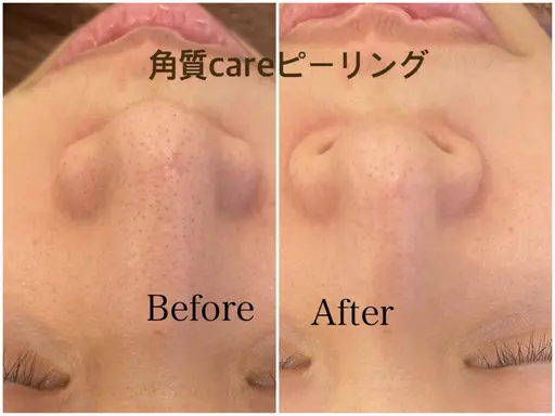 アイリッドアップパーマ&角質ケアピーリング