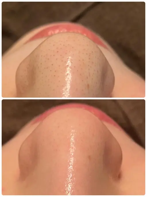 毛穴の黒ずみ徹底除去❗️❗️リンパマッサージ&パック付き✨8800円➡︎7040円