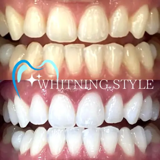 【人気No.1👑】90%の方が選ぶ🔥30分×8来店(1回あたり約4,000円)セルフホワイトニング🦷🔥