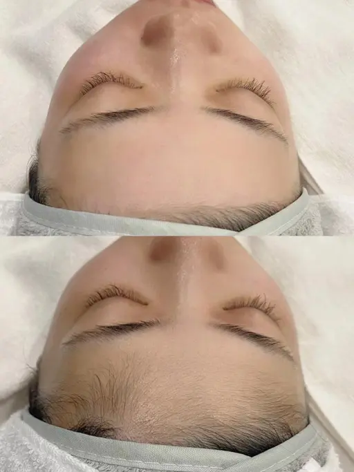 お肌のムダ毛・産毛さようなら👋🏼 ウルツヤモチで最高にモテ肌が手に入ります🧖🏼‍♀️♡見えない産毛までゴッソリ！