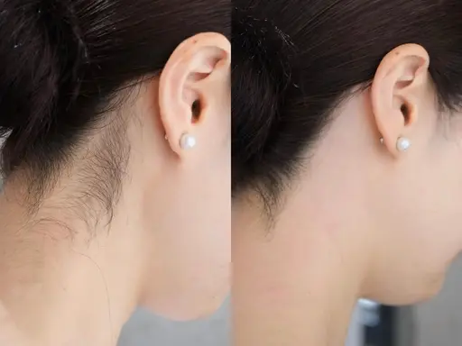 🎀ミニモ限定🎀【うなじ+もみあげワックス脱毛】➕おでこワックス無料✨美人力を高める！ブライダル/イベント前にも