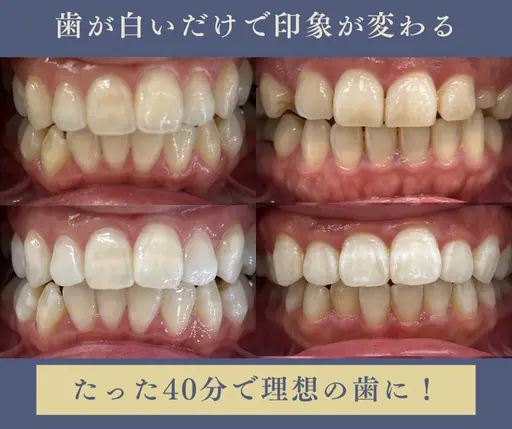 【ミニモ限定価格】ホワイトニング¥8800円→4600円🦷✨