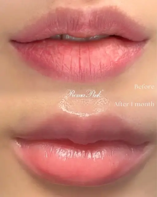 黒ずみ・くすみ除去!バストトップ・唇♪【ローマピンク★無料相談30分】黒ずみを赤ちゃんピンクへ⭐︎