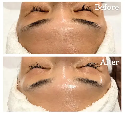 《しわ&たるみ+最強エイジング👩🏻‍⚕️🏅》韓国肌管理ララピールフルコース🤍＋エレクトロポレーション美容液導入