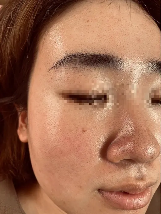 ✨顔全体毛穴洗浄とピールオフパック付き☺️