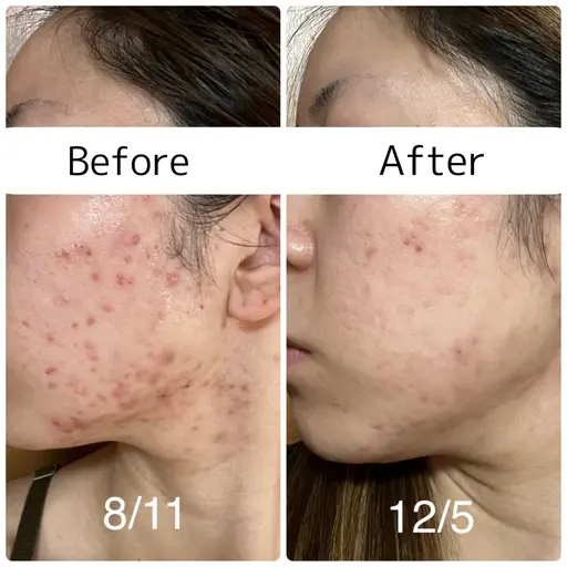 ミニモ限定特別価格🔥🔥【ニキビ撃退コース】