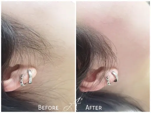 顔シュガーリング🍋脱毛