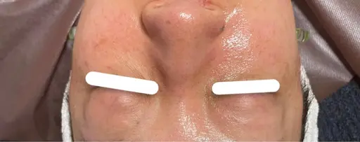 プラズマエステでフェイスラインが綺麗に✨