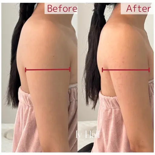 お腹！脂肪にアプローチ　韓国から上陸　話題のRedshot　二の腕スッキリ理想のボディラインへ　　5ｃｃのみ